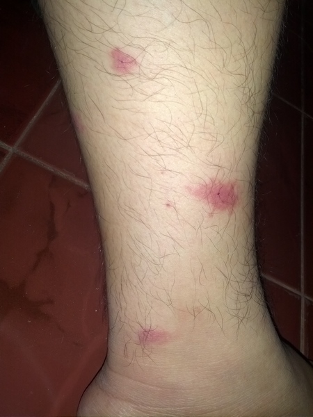 La Piq re De Moustiques Tigres SOLUTY La Piq re De Moustiques Tigres SOLUTY